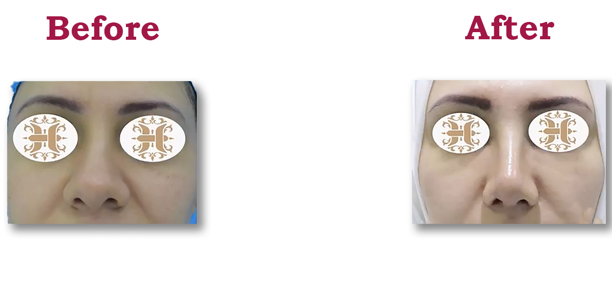 Second slide